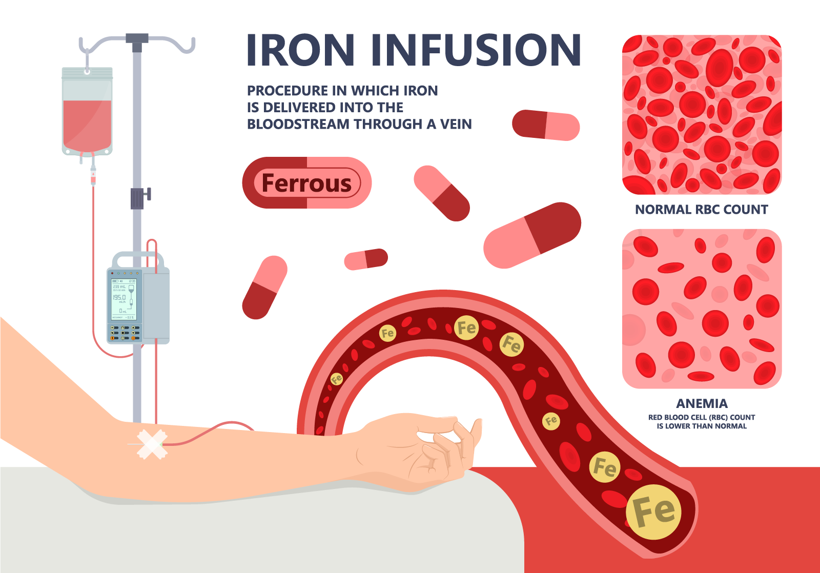 iv iron transfusions for anemia
