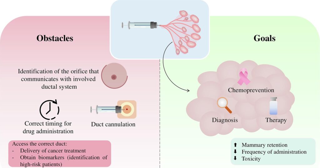 Infographic on nanotechnology for intraductal breast cancer treatment 